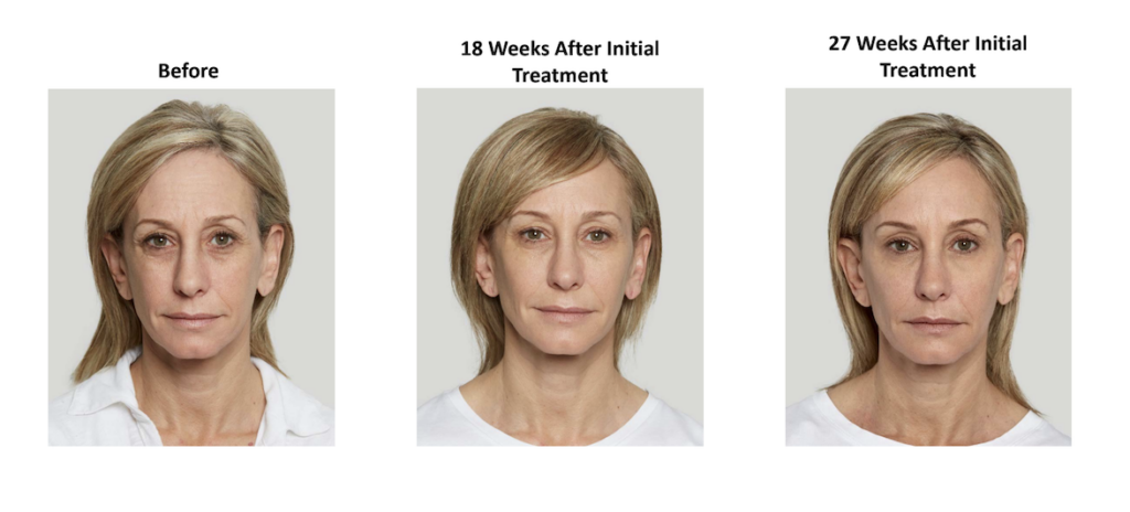 before and after of female patient that's received Sculptra treatment