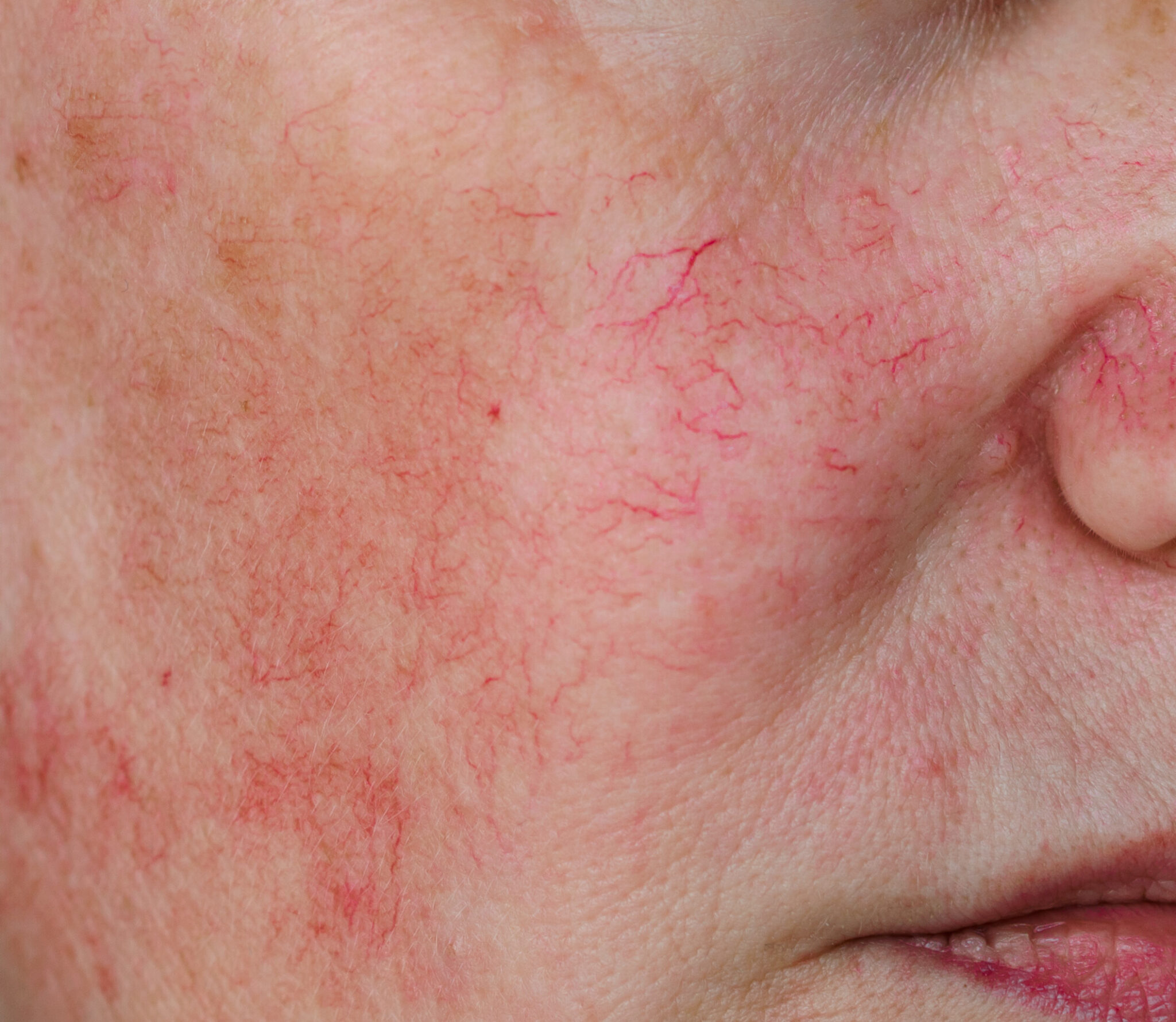 KTP Laser Treatment Franklin Dermatology Group