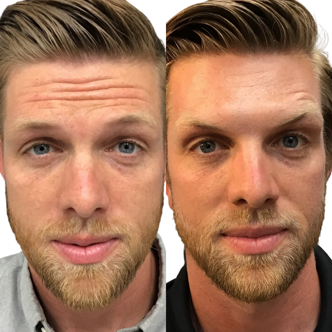 Botox Before And After Men Botox For Men Male Botox Men s Botox