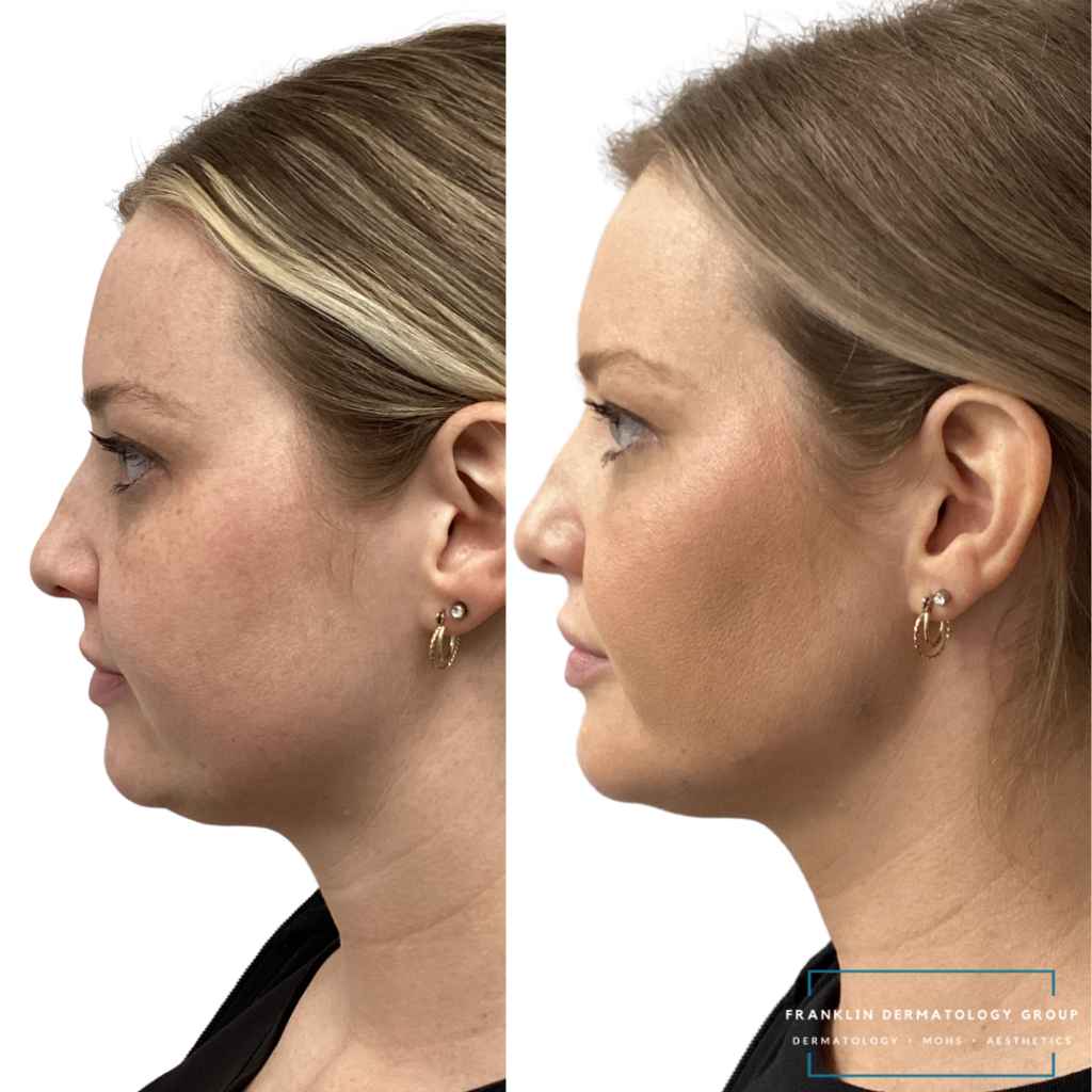 Cosmetic Filler before and after right side - used Juvederm Voluma to cheeks and Juvederm Volux to jawline