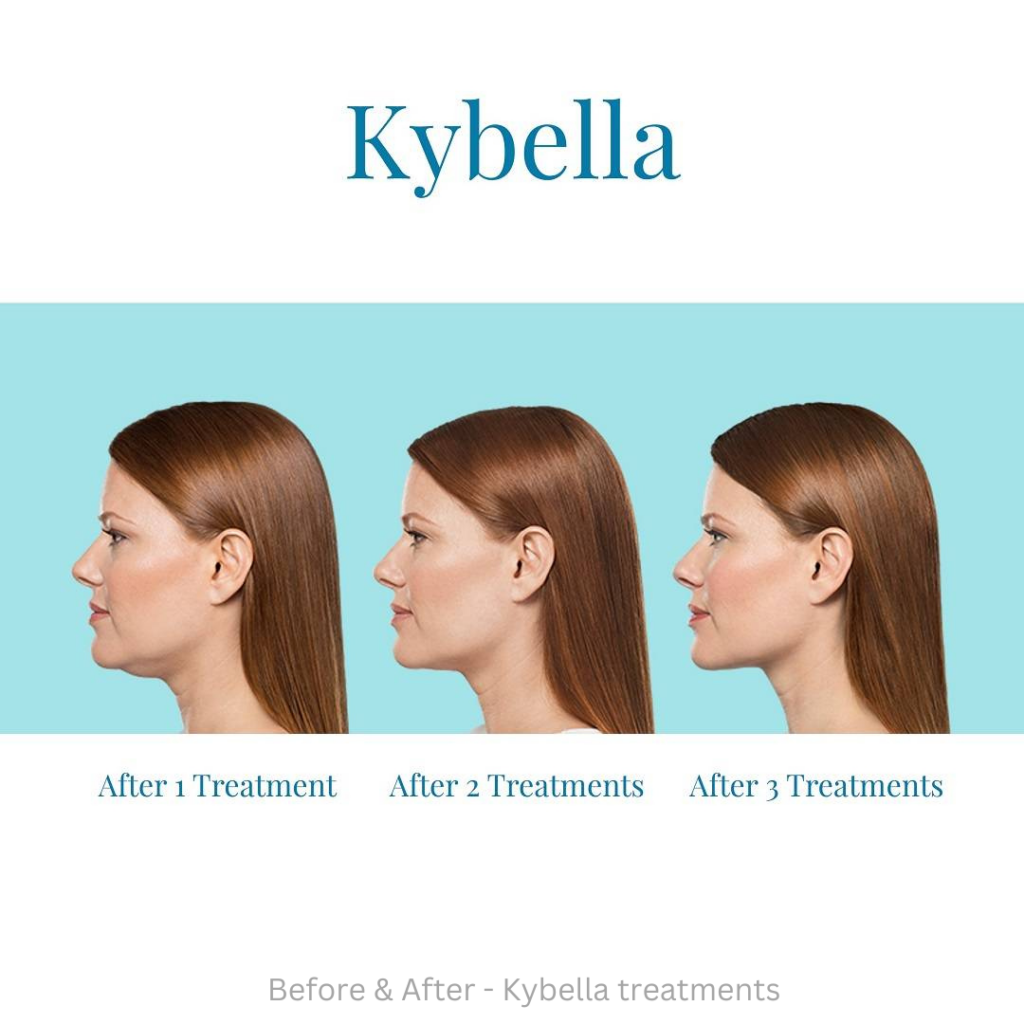Kybella before and after 1, 2 and 3 treatments
